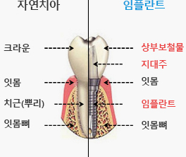 임플란트 모식도(1.자연치아:크라운, 잇몸,치근(뿌리),잇몸뼈 2.임플란트-상부보철물, 지대주, 잇몸, 임플란트 잇몸뼈)