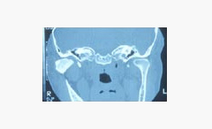 우측 과두가 골절된 방사선사진